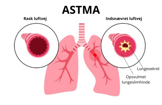 Astma