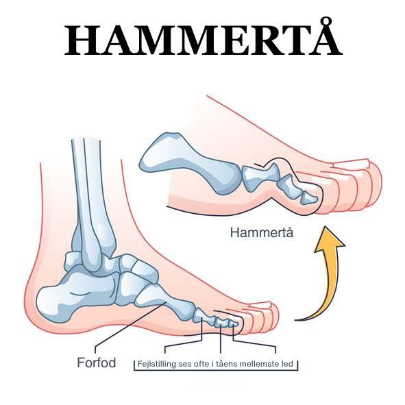 HAMMERTå