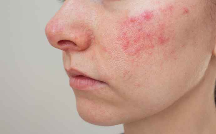 Hvordan kan rosacea behandles?