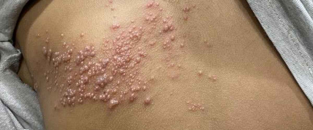 Helvedesild vaccine