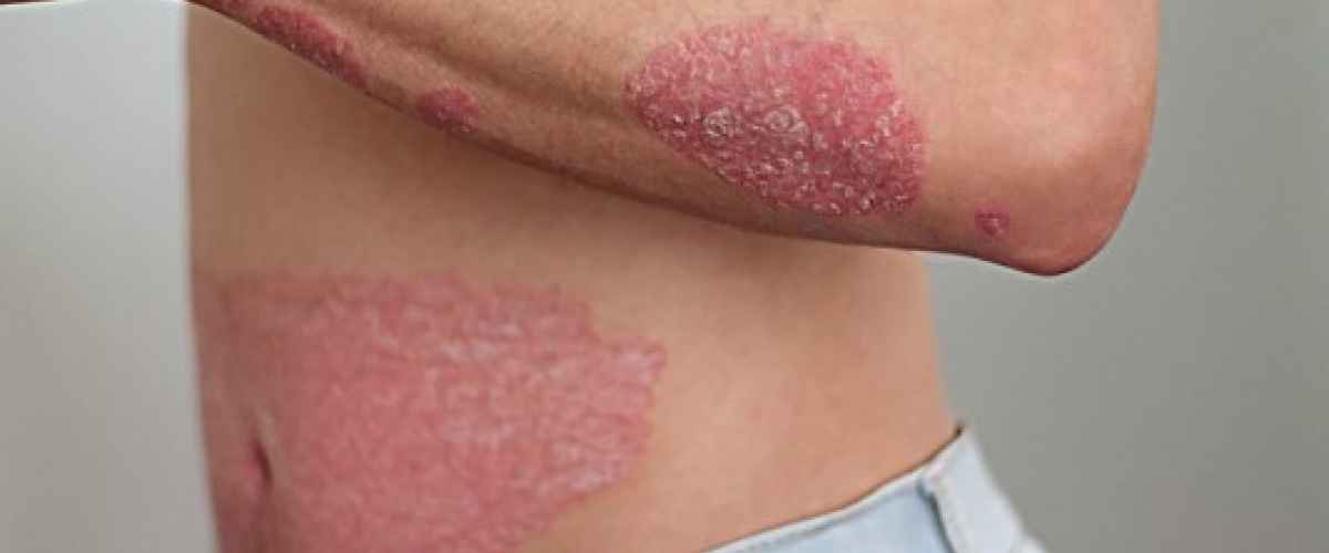 Psoriasis behandling