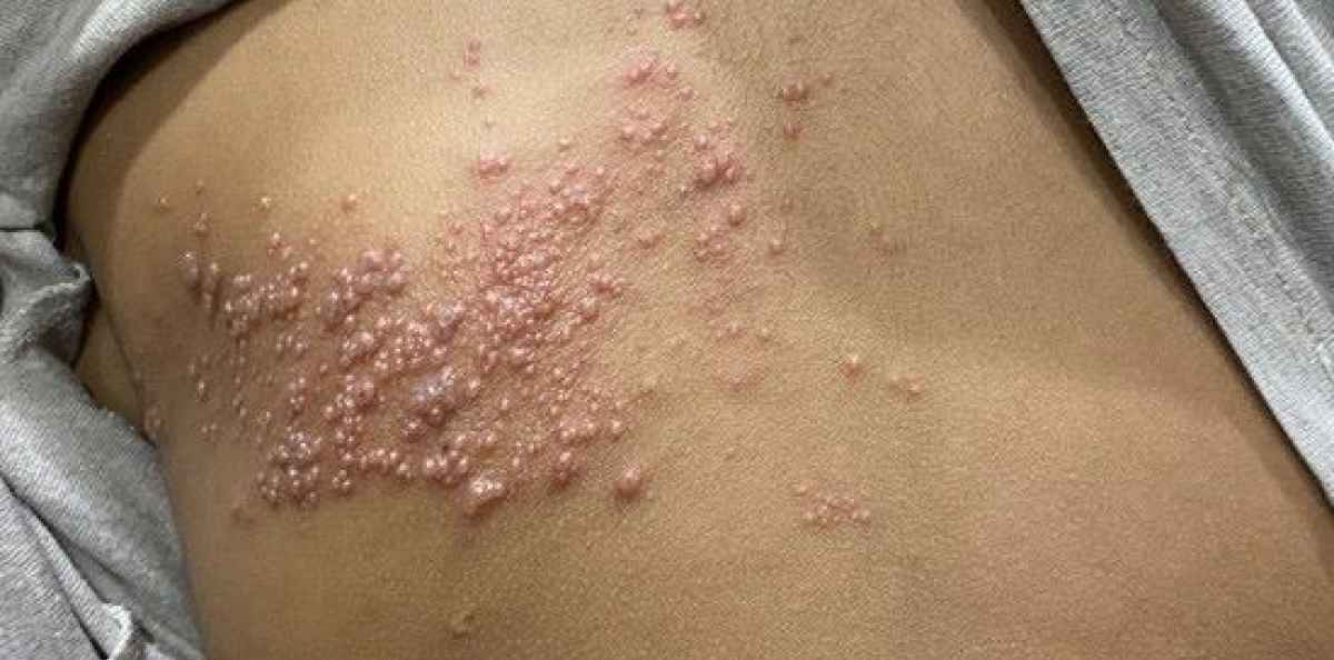 Helvedesild vaccine