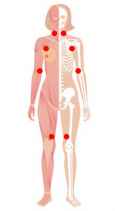 Fibromyalgi symptomer