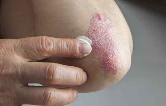 Psoriasis behandling med creme 