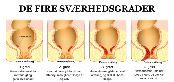 Hæmoridens sværhedsgrader - illustration