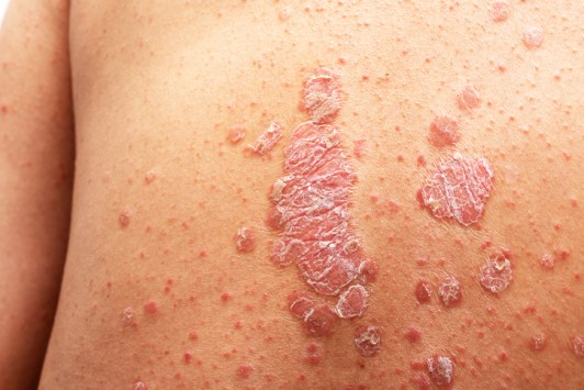 plaque psoriasis4