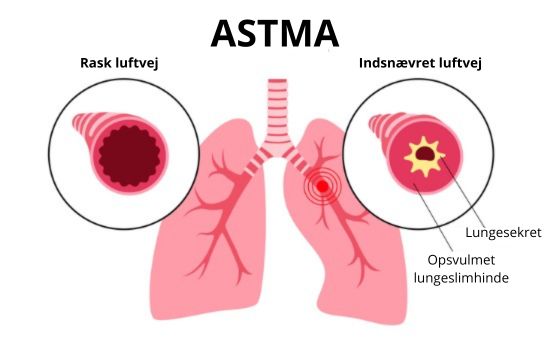 Astma Astma