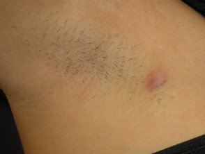 Hidrosadenitis Suppurativa HS