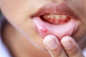 På læben ikke forkølelsessår sår Forkølelsessår