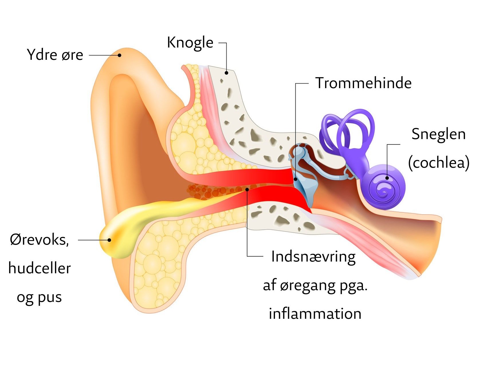 Ørets anatomi. Viser indsnævring af øregang med væske fra øret.