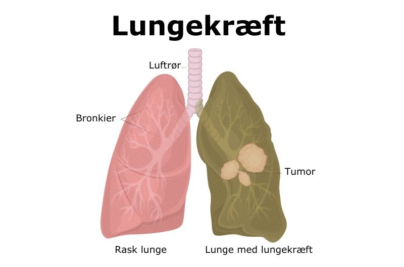 Rask lunge og lunge med kræft. Foto: IStock.com