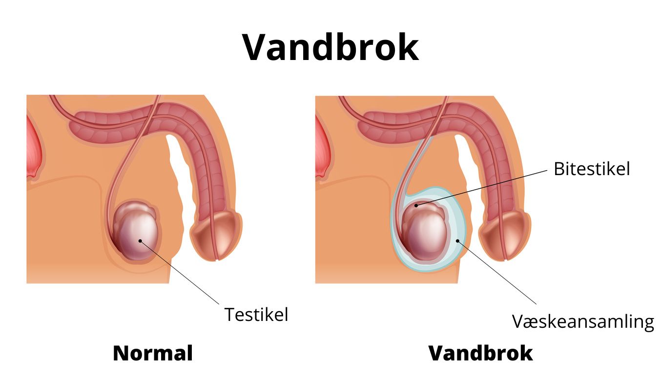 Vandbrok. Illustration: IStock.com