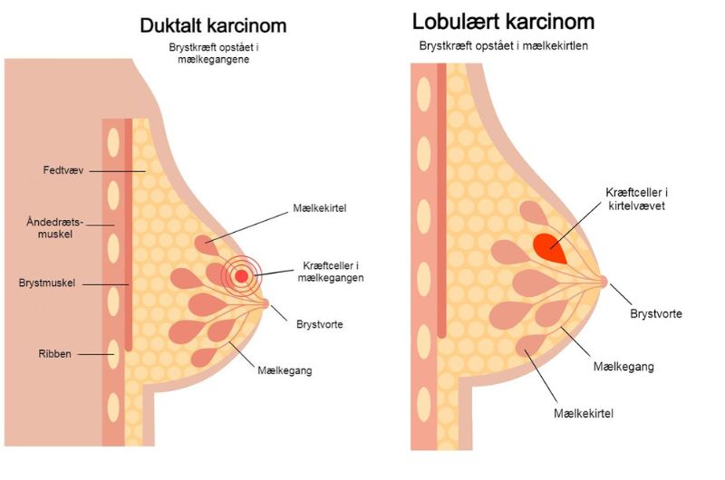 Duktalt og lobulært karcinom