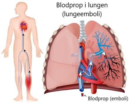 Blodprop i lungen