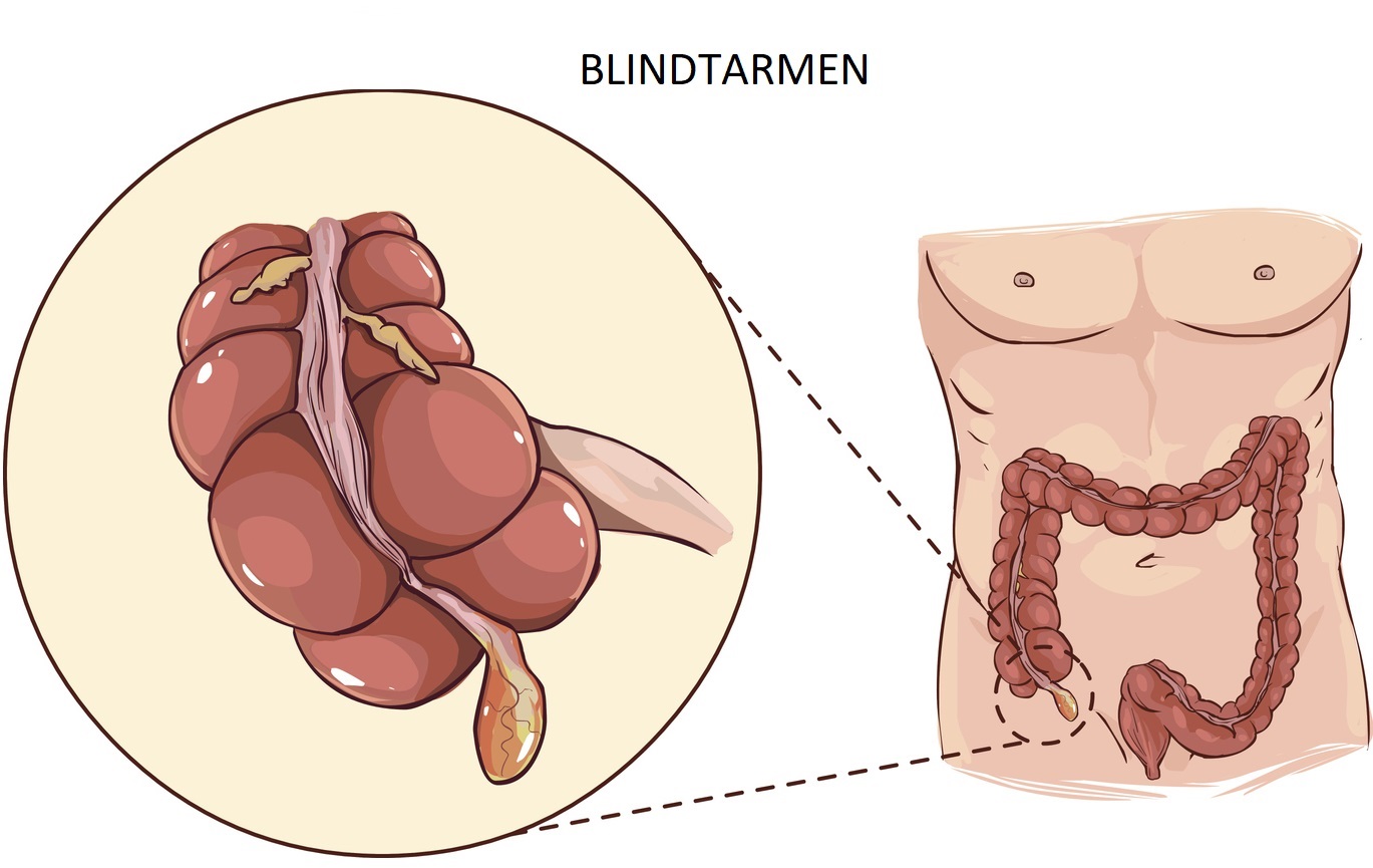 Blindtarmen