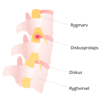 Illustration, der viser hvordan et diskusprolaps ser ud. Diskusprolaps