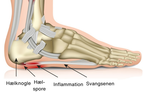 Illustration, der viser svangsenen, hælknoglen og inflammationen i svangsenen kaldet hælspore Hælspore illustration